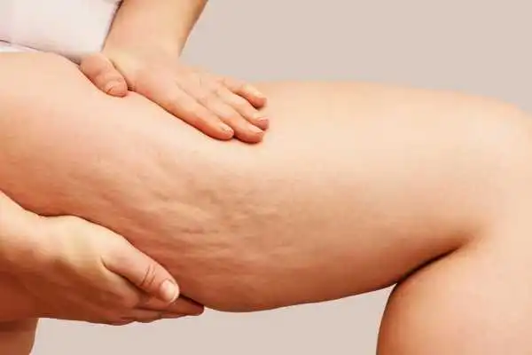 Image of woman showing leg with cellulite Whitley Sands