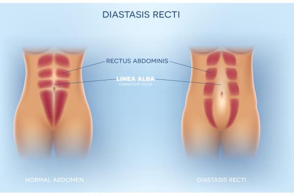 What Non-Surgical Options Are Available for Diastasis Recti Whitley Sands?