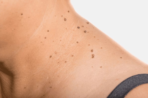 Are you looking for easy skin tag removal Whitley Sands - then contact Spire today!