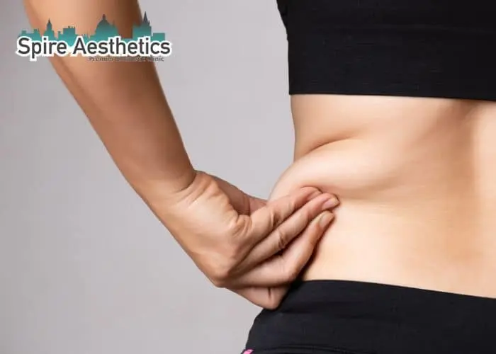 Image of woman pinching fat on their hips Whitley Sands. Fat Freezing treatment