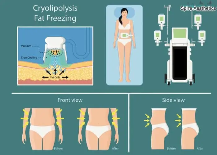 Fat freezing treatment Whitley Sands benefits for competitions to remove stubborn fat deposits.