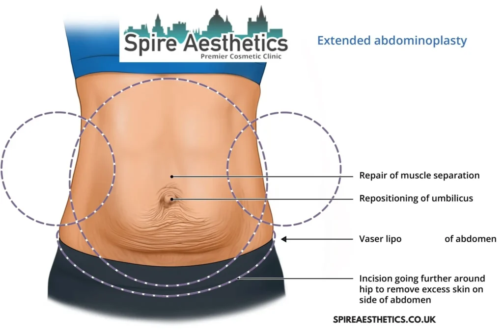 Understanding Loose Skin After Gastric Band Whitley Sands Surgery and HIFU Treatment
