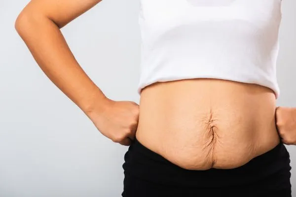 Image of a woman's stomach after weight loss with sagging skin following a gastric band Whitley Sands